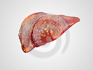 Realistic illustration of cirrhosis of human liver