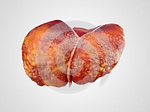 Realistic illustration of cirrhosis of human liver