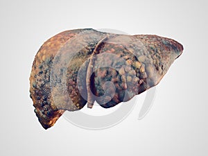 Realistic illustration of cirrhosis of human liver