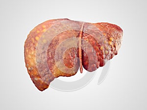 Realistic illustration of cirrhosis of human liver photo