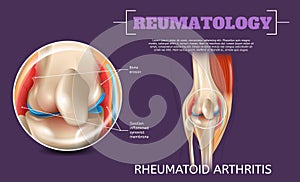 Realistic Illustration Knee Rheumatoid Arthritis