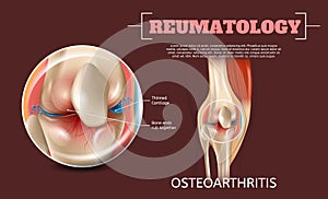 Realistic Illustration Osteoarthritis Knee Joint