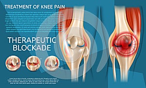 Realistic Illustration Treatment of Knee Pain
