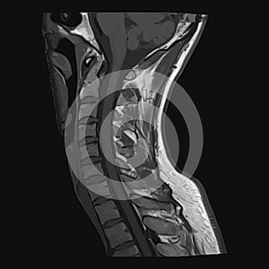 Realistic image sagittal of cervical spine with CT scan, MRI Magnetic resonance imaging layer of spine neck.