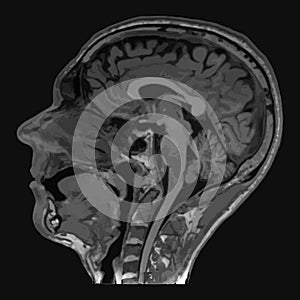 Realistic image sagittal of male head with CT scan, MRI Magnetic resonance imaging layer of head. Isolated on dark