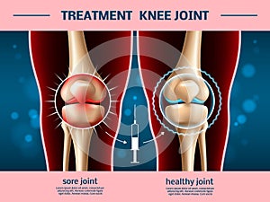 Realistic knee joints. Osteoarthritis treatment, anti inflammatory injection, 3d anatomical part, leg bones and photo