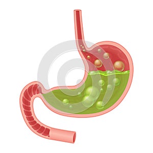 Realistic medical illustration of nausea stomach isolated. Green liquid inside stomach. photo