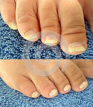 Realistic pedicure, chiropody: before and after photo