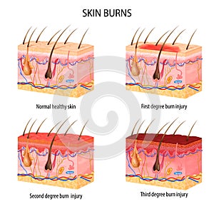 Realistic Skin Burn Classification
