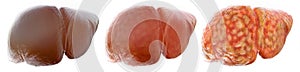 Realistic stages of a fatty liver - 3D Rendering