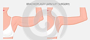 Plastic surgery_Brachioplasty or Upper-Arm Lift photo