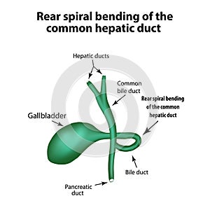 Rear spiral bending of the common hepatic duct. Pathology of the gallbladder.