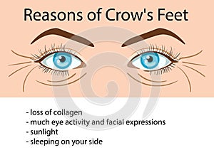 Reasons od Crows feet wrinkles, vector illustration photo