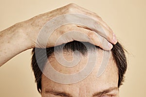 Receding hairline close up