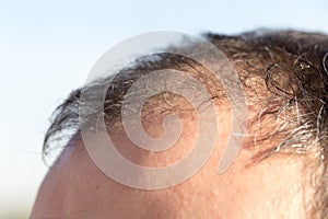 Receding hairline in men photo