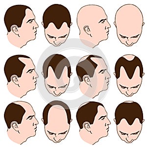 Receding Hairlines photo