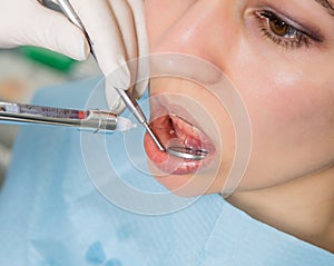 The reception was at the female dentist. Doctor examines the oral cavity on tooth decay. Caries protection. doctor puts