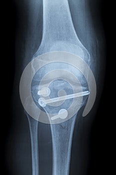 Reconstruction of a right human knee after crash