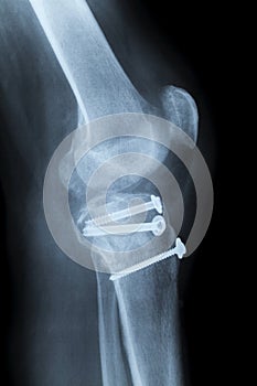 Reconstruction of a right human knee after crash