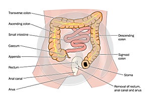Rectal cancer and stoma photo