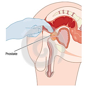 Rectal prostate examination