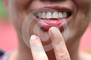 Red aphthae aphthous stomatitis on asian woman lip photo