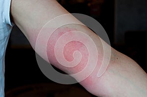 Red arm hurt. Skin allergy photo