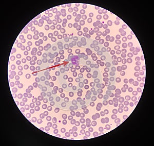 Red arrow showing neutrophil with toxic granule