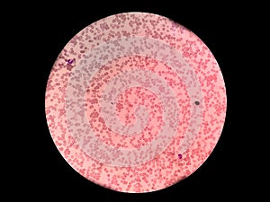 Red blood cell agglutination. RBC Agglutination photo