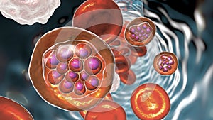 Red blood cell infected with malaria parasite Plasmodium vivax, schizont stage