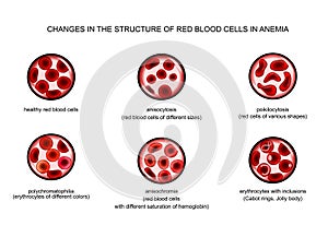 Red blood cells in various anemias