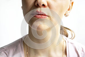 Red bubbles of herpes on lips of a woman in light pink t-shirt, lower part face is seen. Medicine, treatment