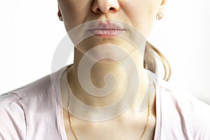 Red bubbles of virus herpes on lips of a woman in light pink t-shirt, lower part face is seen. Medicine, treatment