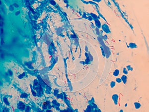 Red cells microbacterium tuberculosis
