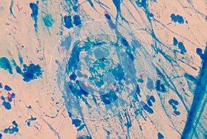 Red cells microbacterium tuberculosis