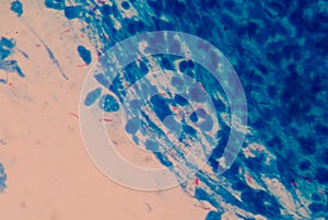 Red cells microbacterium tuberculosis