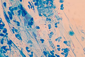 Red cells microbacterium tuberculosis