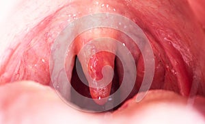 Red, inflamed and swollen uvula in the throat. Treatment of uvulitis due to bacteria and streptococcal viruses