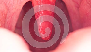 Red, inflamed and swollen uvula in the throat. Treatment of uvulitis due to bacteria and streptococcal viruses photo
