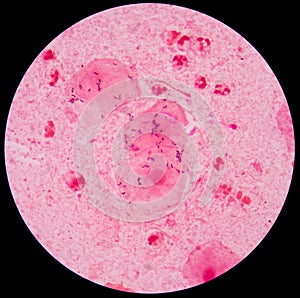 Red leukocyte in sputum gram stain photo