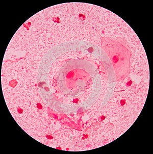 Red leukocyte in sputum gram stain photo