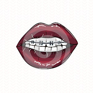 red lips braces illustration. Erotic playful hot clipart. Modern smile fashion illustration. Pop art open mouth with teeth an