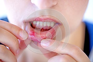 Red and painful canker sore photo