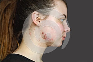 Red pimples on the skin of a young girl close-up. Acne on the face of a teenage girl.  Problems and treatment of acne in young peo