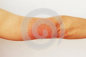 Red pustules and vesicles on the skin of the hand as symptoms of photodermatitis. Allergic reaction to sunlight. Allergy