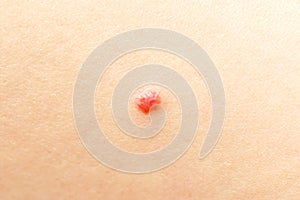 Red spot on skin