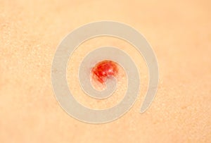 Red spot on skin