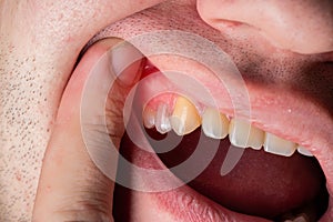 Red and swollen gums in a man. Gum disease gingivitis, flux and inflammation. Macro