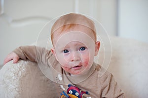 Redhead baby with atopic dermatitis photo