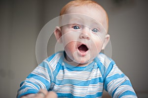 Boy with atopic dermatitis